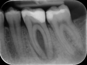 endodontics, endodontie, vandendael, cvore, everberg, kortenberg, brussel, tandarts, dentist