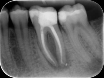 endodontics, endodontie, tandarts, dentist, vandendael, everberg, kortenberg, tandheelkunde