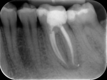 endodontie, endodontics, tandarts, dentist, vandendael, everberg, kortenberg